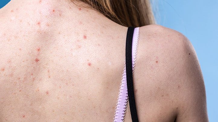 How to Treat Acne in Minimum Time?